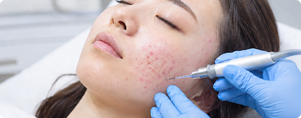 Pimple Care Program
